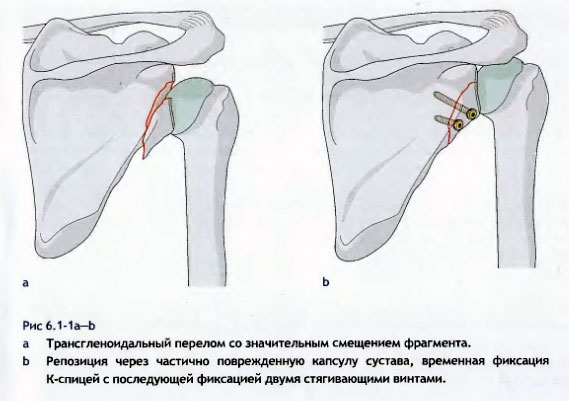 Лечение суставных переломов лопатки ГУ Институт ортопедии и травматологии НАМН Украины Лечение суставных переломов лопатки ГУ Институт ортопедии и травматологии НАМН Украины