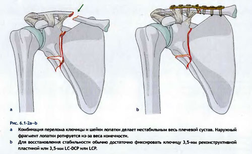 Лечение переломов лопатки и ключицы ГУ Институт ортопедии и травматологии НАМН Украины
