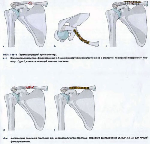 Лечение переломов диафиза ключицы