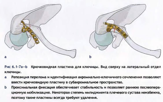 Лечение вывиха акромиального конца ключицы Лечение вывиха акромиального конца ключицы