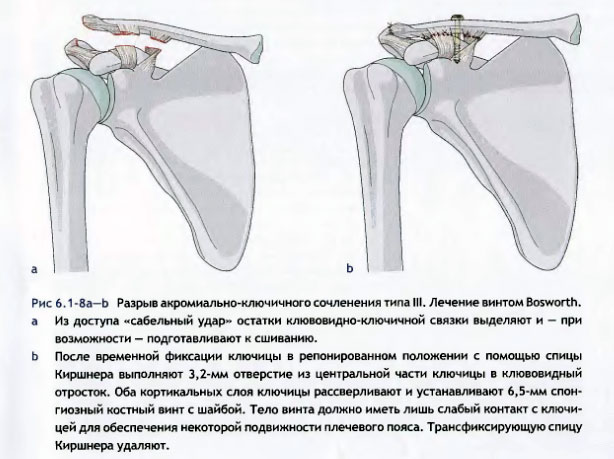 Лечение вывиха грудинного конца ключицы