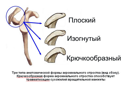 Три типа анатомической формы акромиального отростка (вид сбоку) Три типа анатомической формы акромиального отростка (вид сбоку)