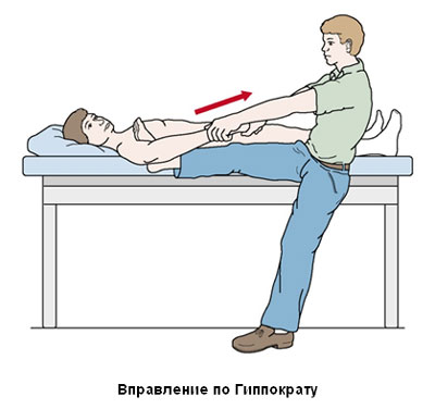 Вправление вывихов плеча способом Гиппократа Вправление вывихов плеча способом Гиппократа
