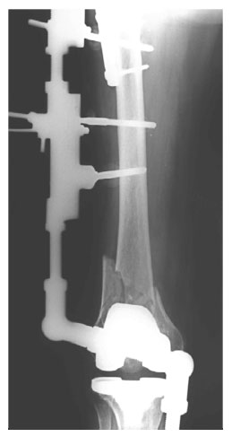 Первичная лечебная чрезсуставная иммобилизация стержневым аппаратом Первичная лечебная чрезсуставная иммобилизация стержневым аппаратом