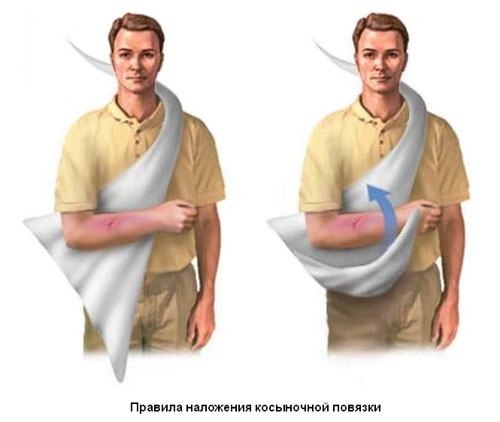 Правила наложения косыночной повязки Правила наложения косыночной повязки