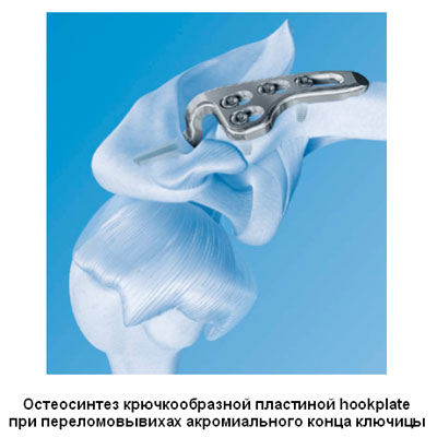 Остеосинтез крючкообразной пластиной hookplate при переломовывихах акромиального конца ключицы Остеосинтез крючкообразной пластиной hookplate при переломовывихах акромиального конца ключицы