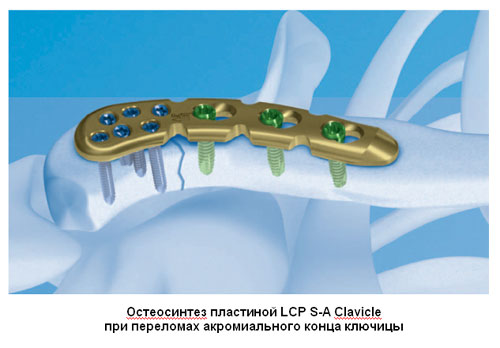 Остеосинтез пластиной LCP S-A Clavicle при переломах акромиального конца ключицы Остеосинтез пластиной LCP S-A Clavicle при переломах акромиального конца ключицы