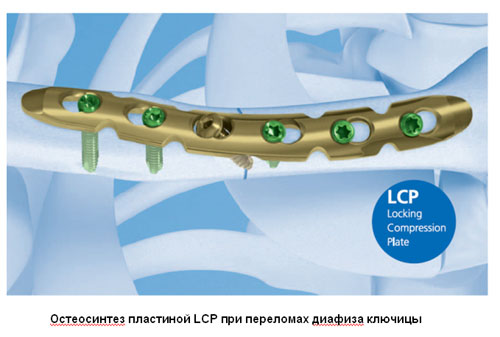 Остеосинтез пластиной LCP при переломах диафиза ключицы Остеосинтез пластиной LCP при переломах диафиза ключицы