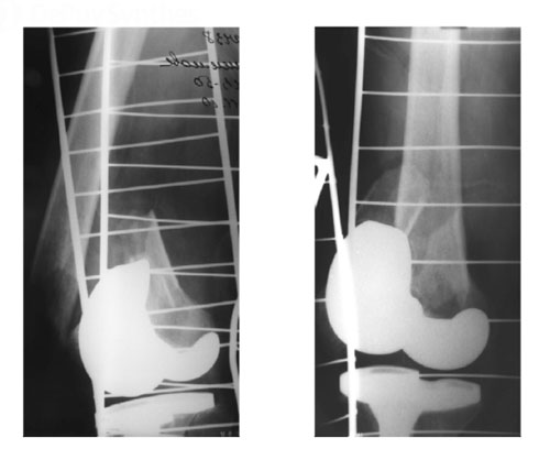 Открытый оскольчатый перипротезный перелом правого бедра Открытый оскольчатый перипротезный перелом правого бедра