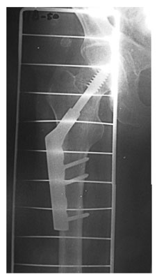 Консолидированный стабильный чрезвертельный перелом правого бедра Консолидированный стабильный чрезвертельный перелом правого бедра