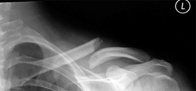 Переломы ключицы Переломы ключицы