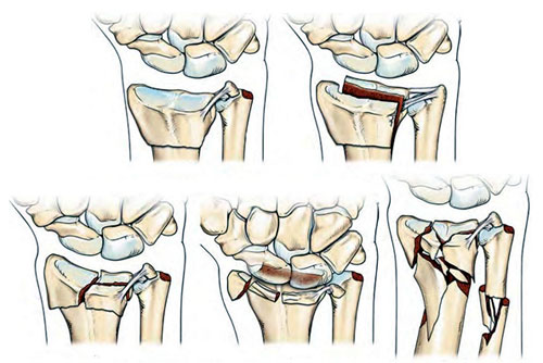 Лечении переломов лучевой кости Лечении переломов лучевой кости