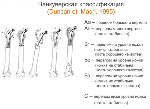 Ванкуверская классификация
