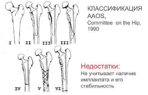 КЛАССИФИКАЦИЯ AAOS