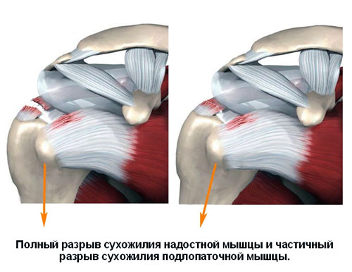 Полный разрыв сухожилия надостной мышцы и частичный разрыв сухожилия подлопаточной мышцы