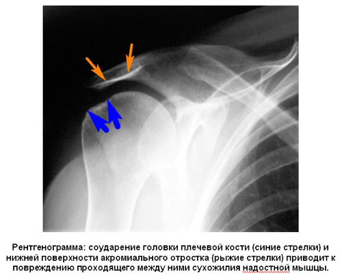 Рентгенограмма: соударение головки плечевой кости (синие стрелки) и нижней поверхности акромиального отростка (рыжие стрелки) приводит к повреждению проходящего между ними сухожилия надостной мышцы