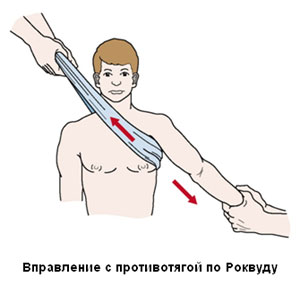 Вправление вывихов плеча с противотягой по Роквуду Вправление вывихов плеча с противотягой по Роквуду