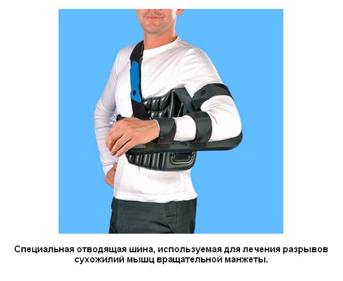 Специальная отводящая шина, используемая для лечения разрывов сухожилий мышц вращательной манжеты Специальная отводящая шина, используемая для лечения разрывов сухожилий мышц вращательной манжеты